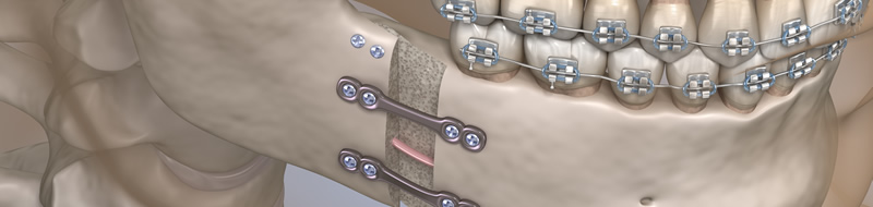 Cirurgia Ortognática