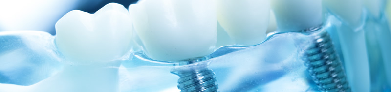 Implantes dentários